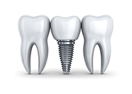 Dental Implants Near Me Serving Santa Monica, Los Angeles, CA Dental Implants Near Me Serving Santa Monica, Los Angeles, CA